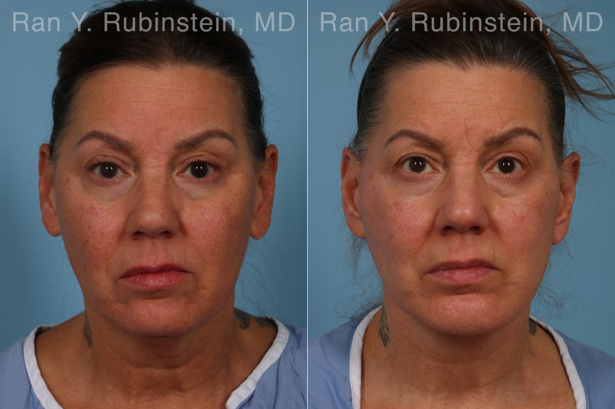 Face lift & Neck lift Before and After Photos in Montvale, NJ, Patient 32263