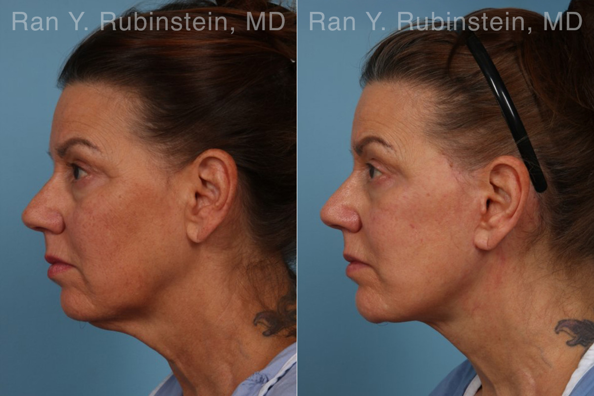 Face lift & Neck lift Before and After Photos in Montvale, NJ, Patient 32263