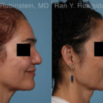 Non-Surgical Rhinoplasty Before and After Photos in Montvale, NJ, Patient 32272