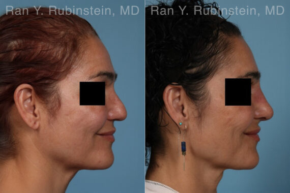 Non-Surgical Rhinoplasty Before and After Photos in Montvale, NJ, Patient 32272