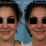 Non-Surgical Rhinoplasty Before and After Photos in Montvale, NJ, Patient 32272