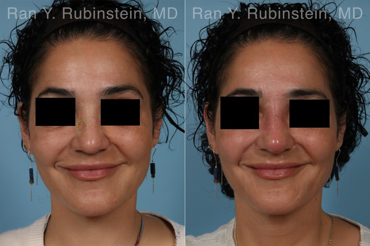 Non-Surgical Rhinoplasty Before and After Photos in Montvale, NJ, Patient 32272