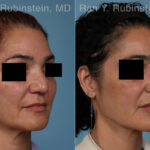 Non-Surgical Rhinoplasty Before and After Photos in Montvale, NJ, Patient 32272