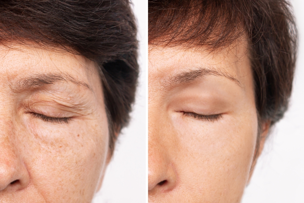 Before and after image showing improved eyelid appearance after ptosis repair and blepharoplasty procedures.