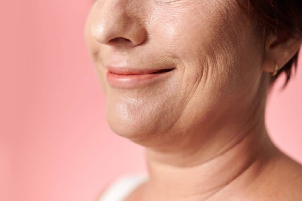 Close-up of woman's lower face showing cheek wrinkles and skin laxity after rapid facial weight loss.