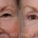 Brow Lift Before and After Photos in Montvale, NJ, Patient 33165