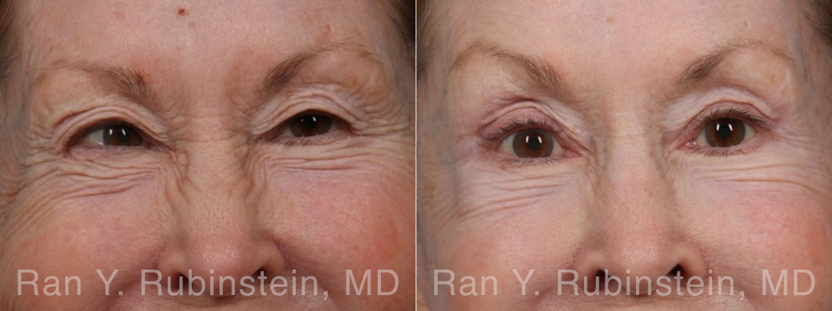 Brow Lift Before and After Photos in Montvale, NJ, Patient 33165