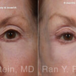 Brow Lift Before and After Photos in Montvale, NJ, Patient 33165