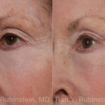 Brow Lift Before and After Photos in Montvale, NJ, Patient 33165