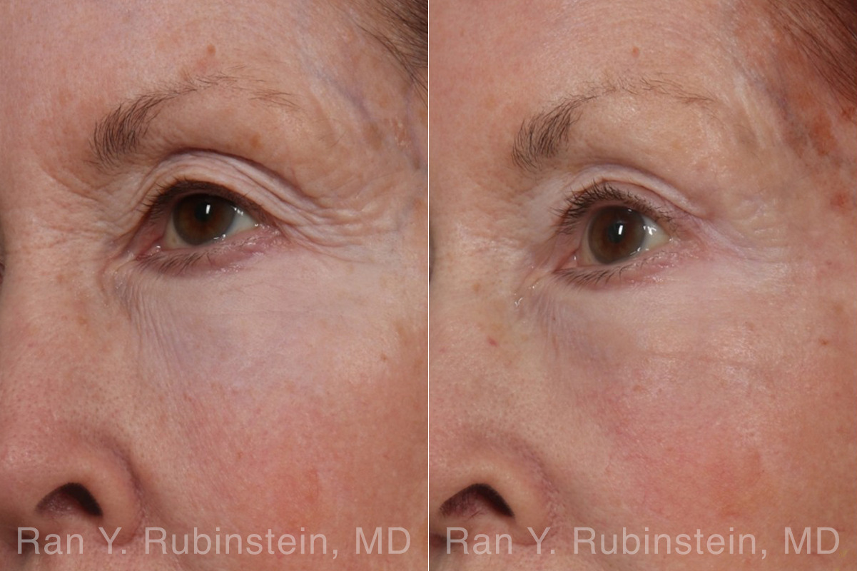 Brow Lift Before and After Photos in Montvale, NJ, Patient 33165