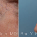 Brow Lift Before and After Photos in Montvale, NJ, Patient 33165