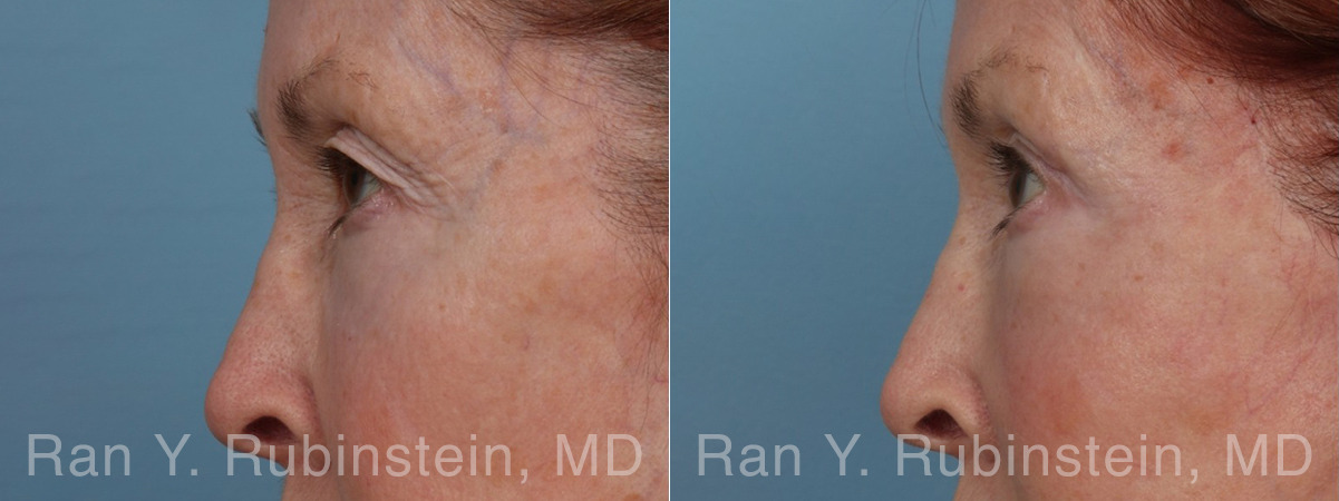 Brow Lift Before and After Photos in Montvale, NJ, Patient 33165