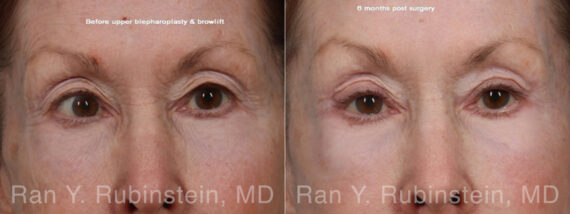 Brow Lift Before and After Photos in Montvale, NJ, Patient 33165