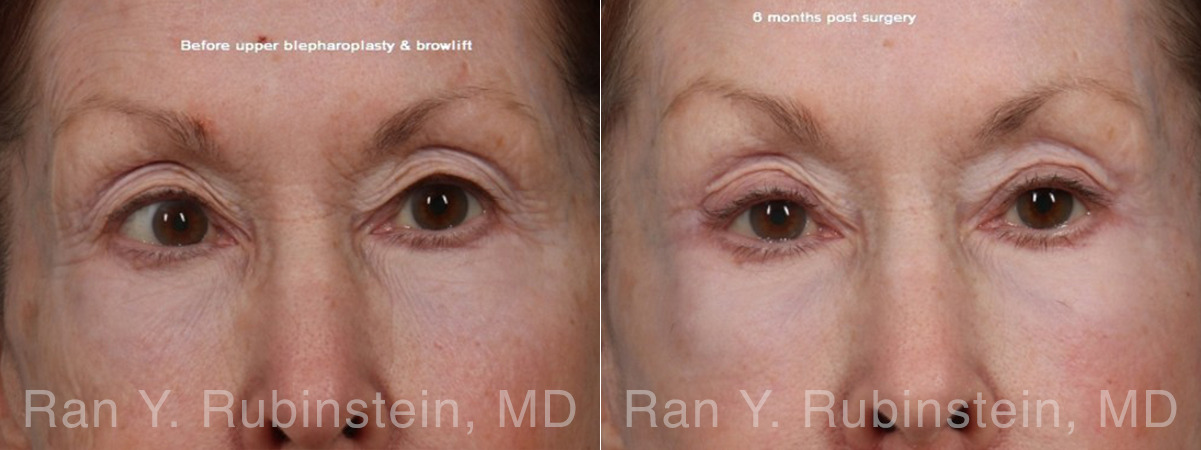 Brow Lift Before and After Photos in Montvale, NJ, Patient 33165