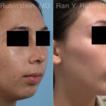 Chin Augmentation Before and After Photos in Montvale, NJ, Patient 33182