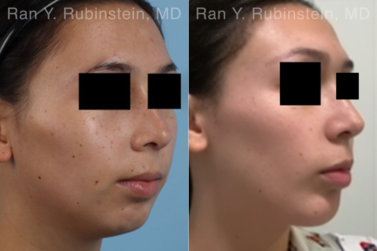 Chin Augmentation Before and After Photos in Montvale, NJ, Patient 33182