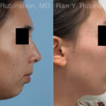 Chin Augmentation Before and After Photos in Montvale, NJ, Patient 33182