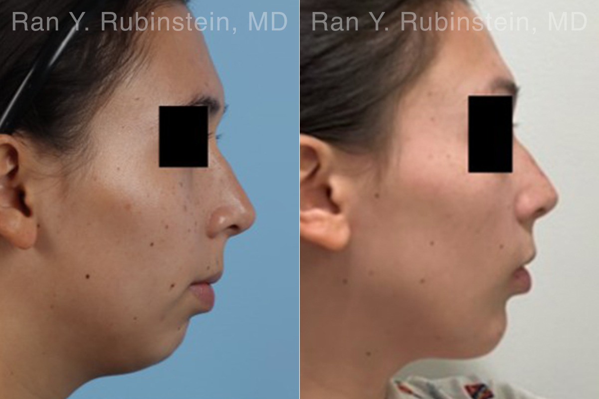 Chin Augmentation Before and After Photos in Montvale, NJ, Patient 33182