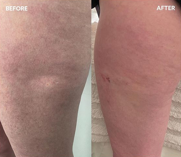 renuva-ba-rubinstein-plastic-surgery-center-11