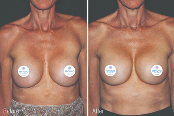 renuva-ba-rubinstein-plastic-surgery-center-16