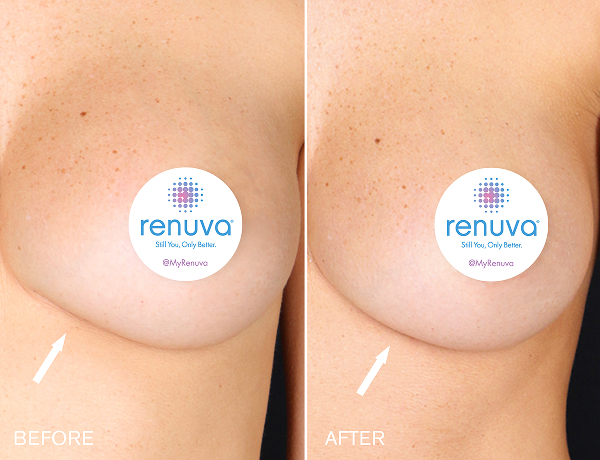 renuva-ba-rubinstein-plastic-surgery-center-17