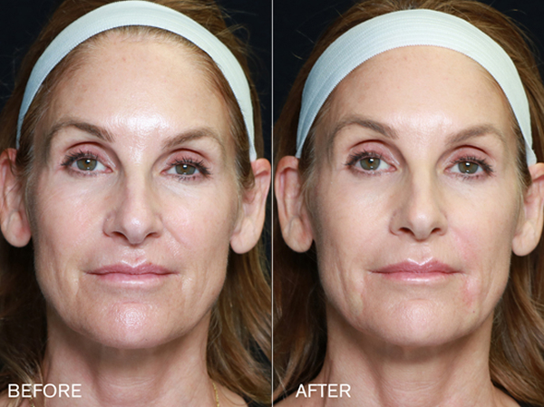 renuva-ba-rubinstein-plastic-surgery-center-4