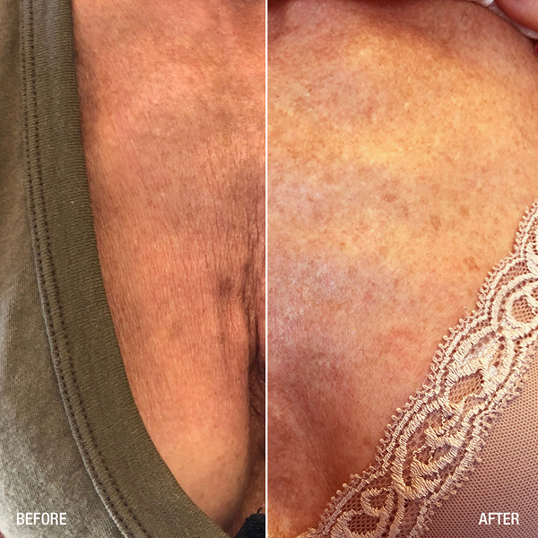 renuva-ba-rubinstein-plastic-surgery-center-5