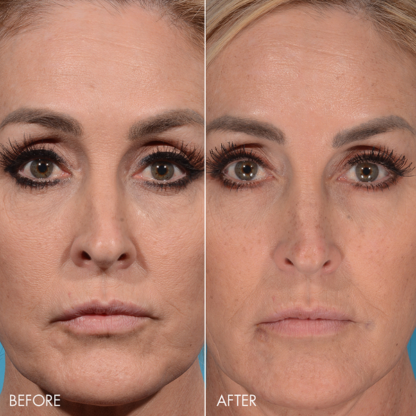renuva-ba-rubinstein-plastic-surgery-center-6