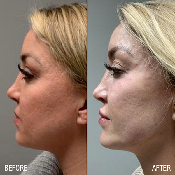 renuva-ba-rubinstein-plastic-surgery-center-7