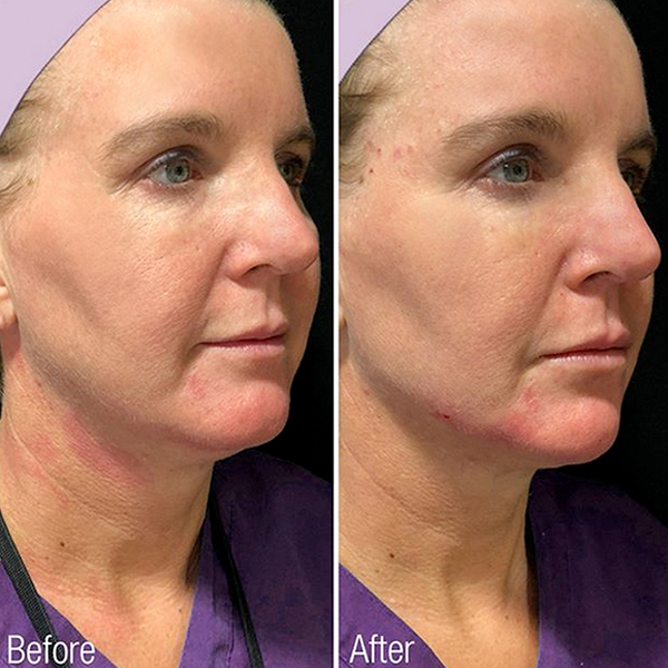 renuva-ba-rubinstein-plastic-surgery-center-9