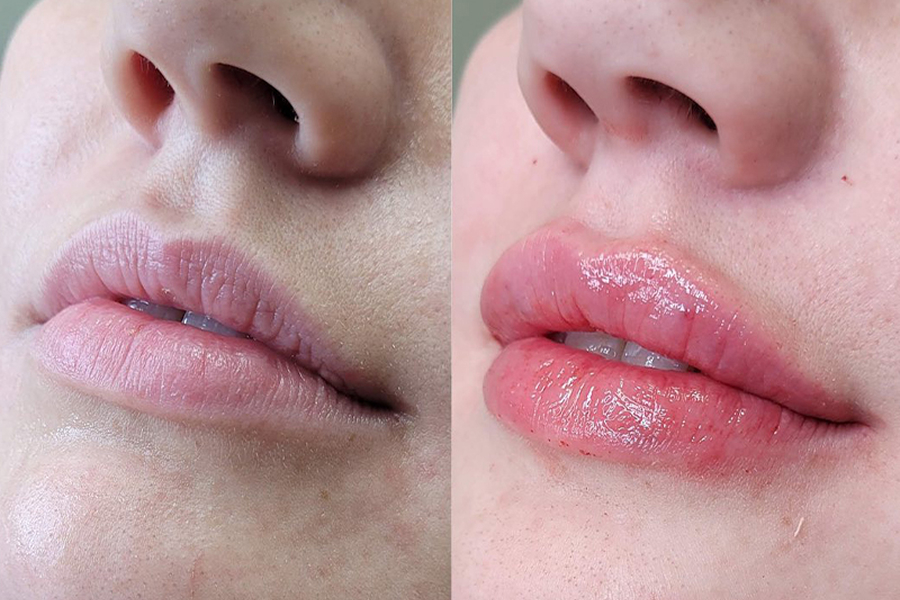 lip-aug-med-spa-4
