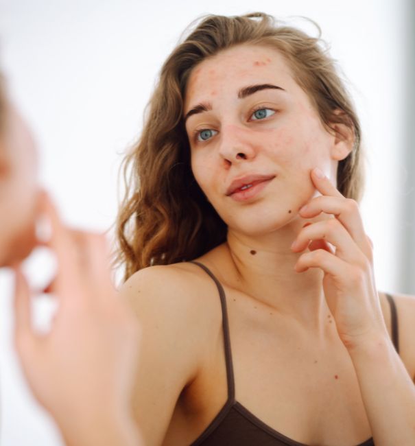 Patient examining acne-prone skin before BioRePeel treatment in Montvale, NJ for clearer tone and smoother texture.