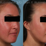 Laser Treatments Before and After Photos in Montvale, NJ, Patient 35091