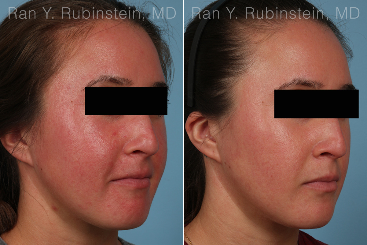 Laser Treatments Before and After Photos in Montvale, NJ, Patient 35091