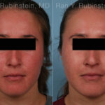 Laser Treatments Before and After Photos in Montvale, NJ, Patient 35091