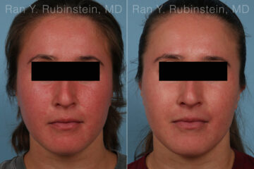 Laser Treatments Before and After Photos in Montvale, NJ, Patient 35091
