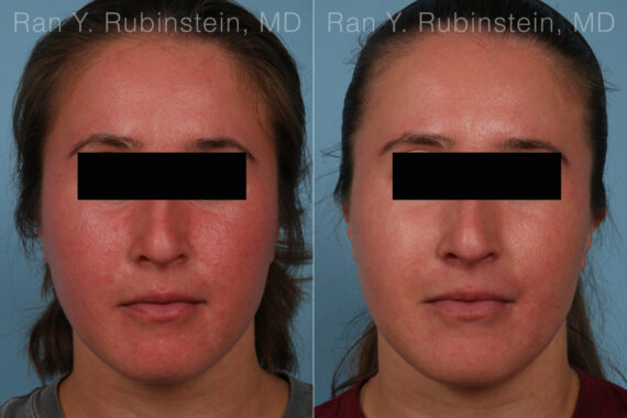 Laser Treatments Before and After Photos in Montvale, NJ, Patient 35091